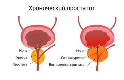 Массаж простаты: польза и вред - dr-nugmanov