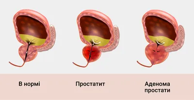 МАВИТ УЛП-01 (MAVIT) Прибор для лечения простатита в домашних условиях