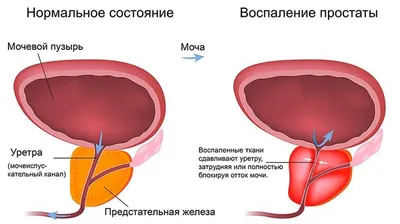 Лечение простатита в Германии