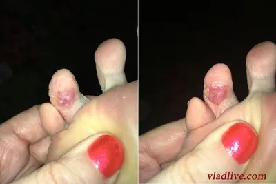 Удивительное фото меланомы на пальце руки в формате PNG