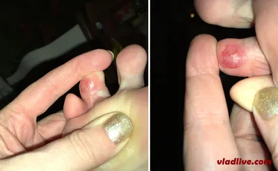 Уникальная фотография меланомы на пальце руки
