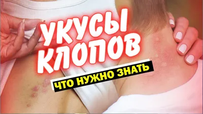 Как выглядит укус клопа? | Клопов не будет