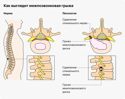 Лечение межпозвоночной грыжи без операции: отзыв, реабилитация, стоимость  терапии