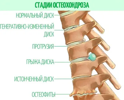 Грыжа поясничного отдела позвоночника: симптомы и лечение в Центре доктора  Бубновского на Авиамоторной