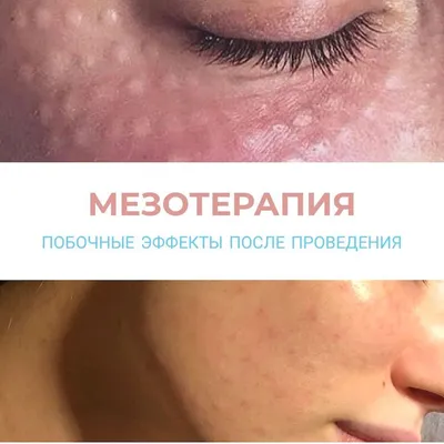 Фракционная мезотерапия кожи лица по низкой цене в Новосибирске. Фото и  отзывы о процедуре