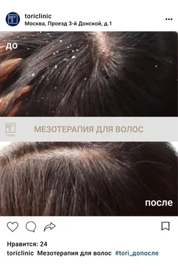 Фракционная мезотерапия головы в Москве цена, отзывы, фото - Косметология  доктора Корчагиной