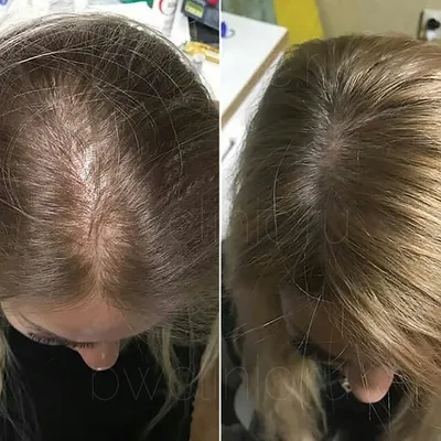 Мезотерапия волос в Чехове от сети клиник «CMD»