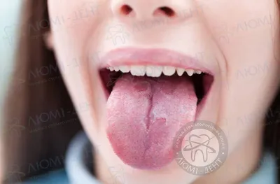 Что делать при появлении молочницы во рту | Стоматология Smile-at-Once |  Дзен