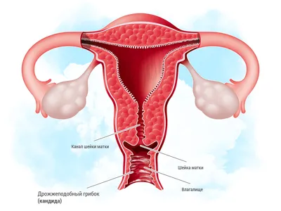 Молочница и бактериальный вагиноз: что это и что делать?