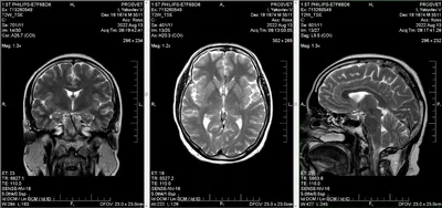 Является Сагиттальным Мрт Головного Мозга — стоковые фотографии и другие  картинки Магнитно-резонансная томография - Магнитно-резонансная томография,  Магнитно-резонансный томограф, Рентгеновский снимок - iStock