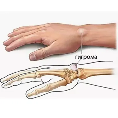 Фотография шишки на руке: бесплатное изображение