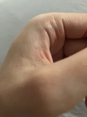 Фотография шишки на руке: как определить размеры