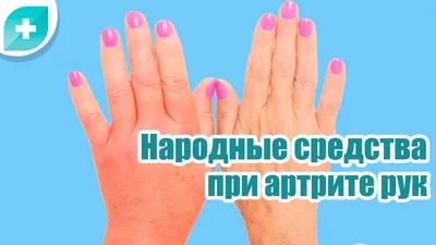 Изображение наростов на суставах пальцев рук: увеличенное изображение