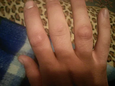 Изображение наростов на суставах пальцев рук