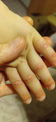 Фото наростов на пальцах рук: высокое разрешение