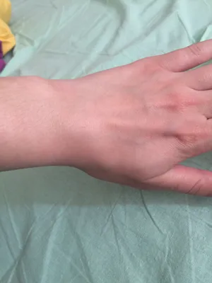 Картинка наростов на суставах пальцев рук: подробная съемка