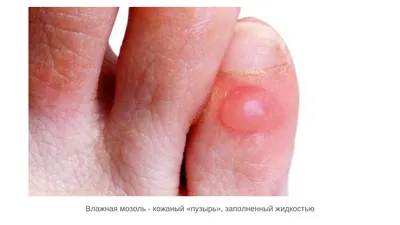 Изображение наростов на суставах пальцев рук: для диагностики