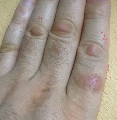 Фото наростов на суставах пальцев рук в формате WebP
