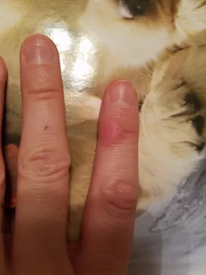 Фото наростов на суставах пальцев рук в макросъемке