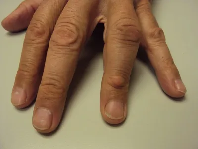 Картинка наростов на суставах пальцев рук в высоком разрешении