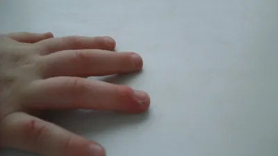 Нарыв на пальце руки: изображение, которое вызывает дискомфорт
