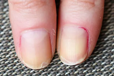 Негрибковые заболевания ногтей на руках фотографии