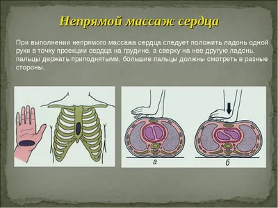 СЛР как возможность спасти чью-то жизнь. | Пикабу