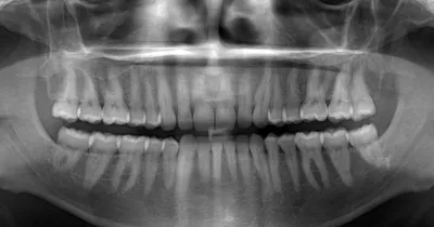 На первый–второй рассчитайсь!» Какие номера присваивают зубам стоматологи |  ortodontcomplex.ru | Дзен