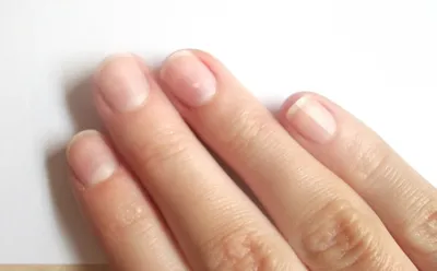 Фото ногтей на руках с грибком