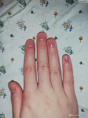 Обгрызенные ногти (61 фото)