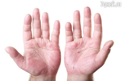 Облазит кожа на пальцах рук: фото в высоком разрешении