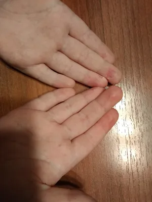 Красивые руки с проблемной кожей: изображение в формате JPG