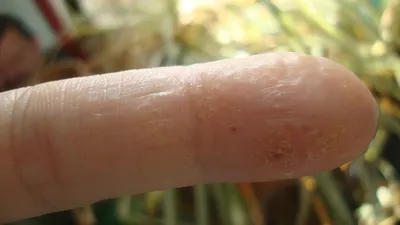 Облезлая кожа на пальцах рук: Картинка в формате WebP