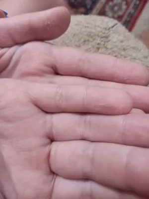 Фотография рук с облезшей кожей в PNG