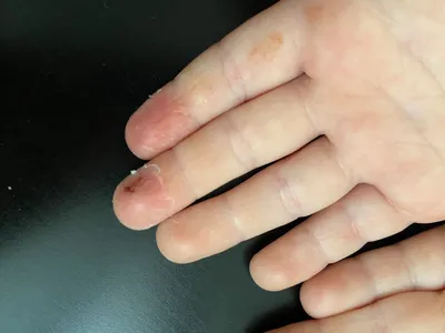 Фото рук с проявлениями аллергии