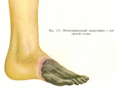 Синдром \"ноги курильщика\" (облитерирующий эндартериит) | Пикабу
