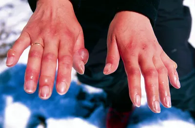 Обморожение рук: фото в высоком разрешении