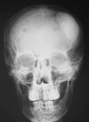 Уникальные изображения остеомы черепа в формате PNG