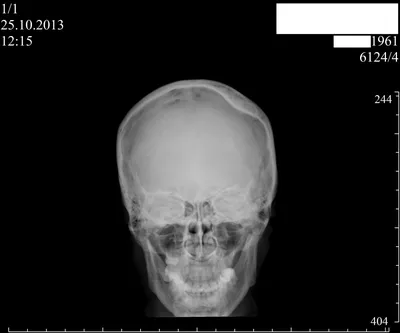 Остеома черепа: Фото для медицинских курсов