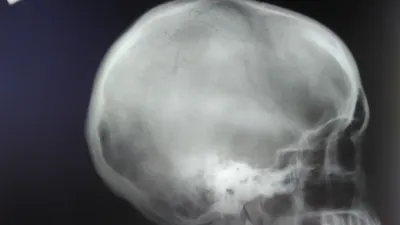 Фото черепа с остеомой: Самые реалистичные изображения