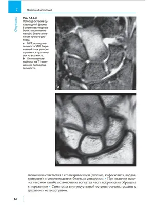 Остеома черепа: Изображения для медицинских исследований