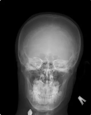 Фотографии остеомы черепа: Самые детальные изображения