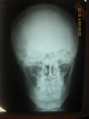 Фото черепа с остеомой: Скачать бесплатно в любом формате