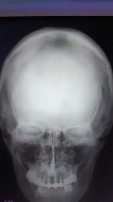 Фотография остеомы черепа: прекрасный выбор для медицинского блога