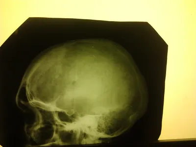 Фотка черепа с остеомой: доступна для загрузки в WebP