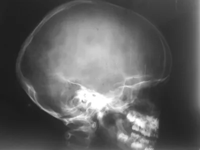 Остеома черепа: Картинки в высоком качестве