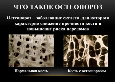 Остеопороз Этапы Изображение — стоковая векторная графика и другие  изображения на тему Остеопороз - Остеопороз, Кость, Поперечный разрез -  iStock