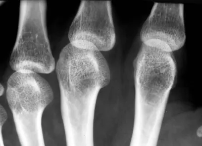 Что такое остеопороз и каковы причины его возникновения? | Royal Medical  Traiding | МЕДИЦИНА И ТЕХНИКА | Дзен