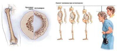 Лечение остеопороза костей в Омске | цены на услуги врача в клинике Центр  EzraMed Clinic