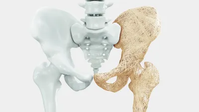 Что такое остеопороз и какие симптомы должны насторожить ? | 17.10.2023 |  Камышин - БезФормата